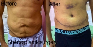 Dr Sheraz Raza Liposuction Surgeon