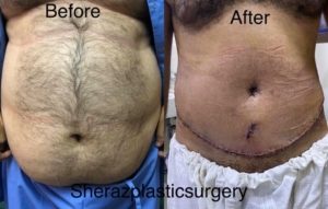 Dr Sheraz Raza Liposuction Surgeon