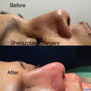 Dr Sheraz Raza Rhinoplasty Surgeon
